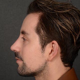 Male Rhinoplasty Before & After Gallery - Patient 343166 - Image 6
