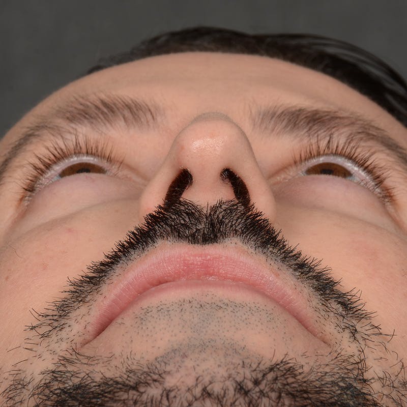 Male Rhinoplasty Before & After Gallery - Patient 343166 - Image 7