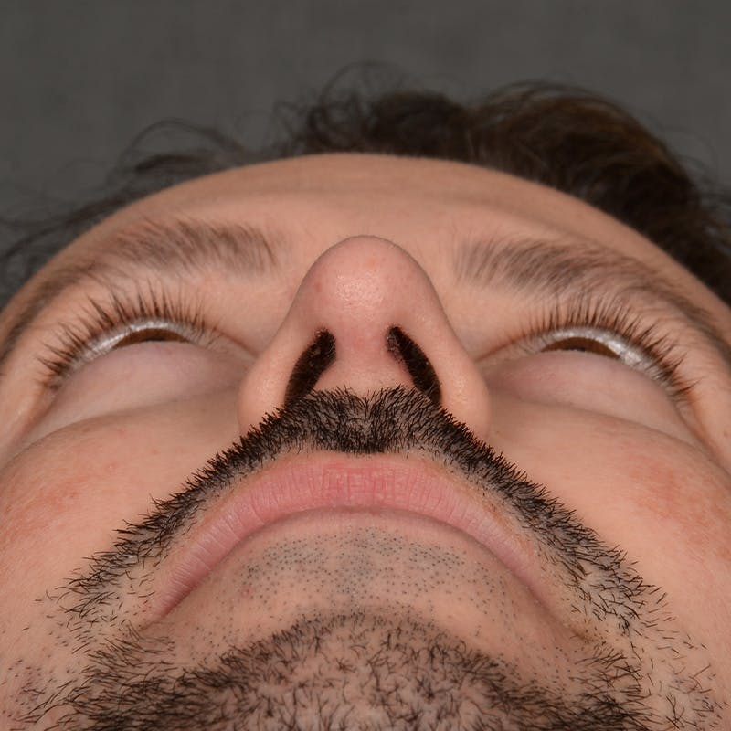 Male Rhinoplasty Before & After Gallery - Patient 343166 - Image 8