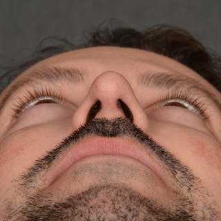 Male Rhinoplasty Before & After Gallery - Patient 343166 - Image 8