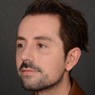 Male Rhinoplasty Before & After Gallery - Patient 343166 - Image 4