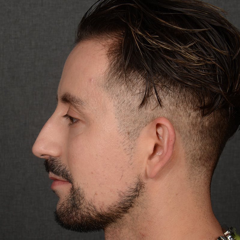 Male Rhinoplasty Before & After Gallery - Patient 343166 - Image 5