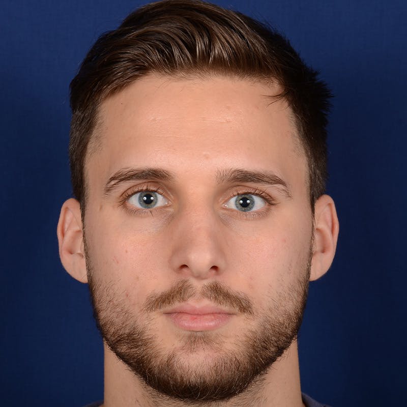 Male Rhinoplasty Before & After Gallery - Patient 915882 - Image 1