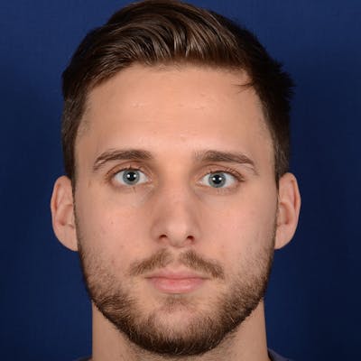 Male Rhinoplasty Before & After Gallery - Patient 915882 - Image 1