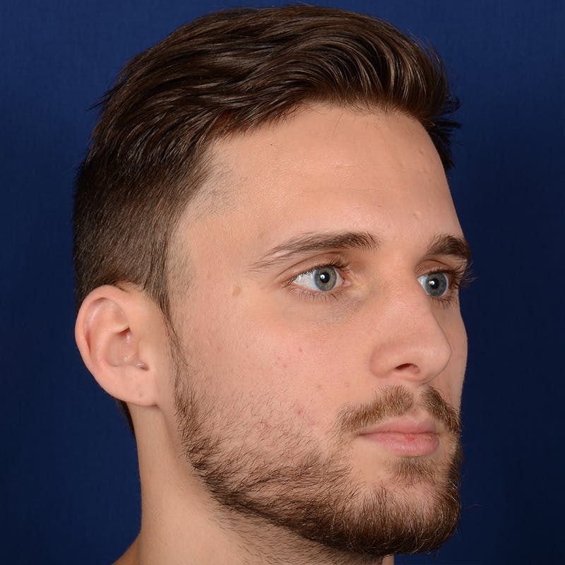 Male Rhinoplasty Before & After Gallery - Patient 915882 - Image 4