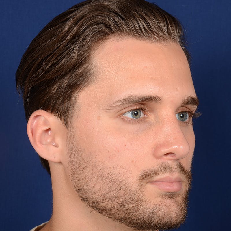 Male Rhinoplasty Before & After Gallery - Patient 915882 - Image 3