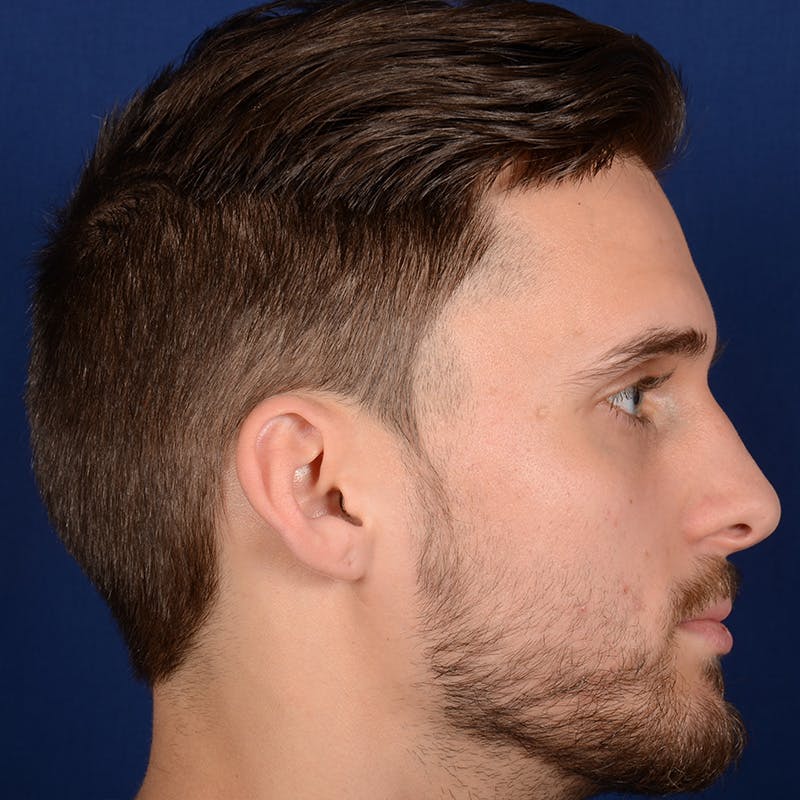 Male Rhinoplasty Before & After Gallery - Patient 915882 - Image 5