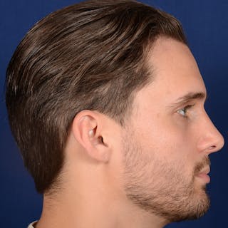 Male Rhinoplasty Before & After Gallery - Patient 915882 - Image 6