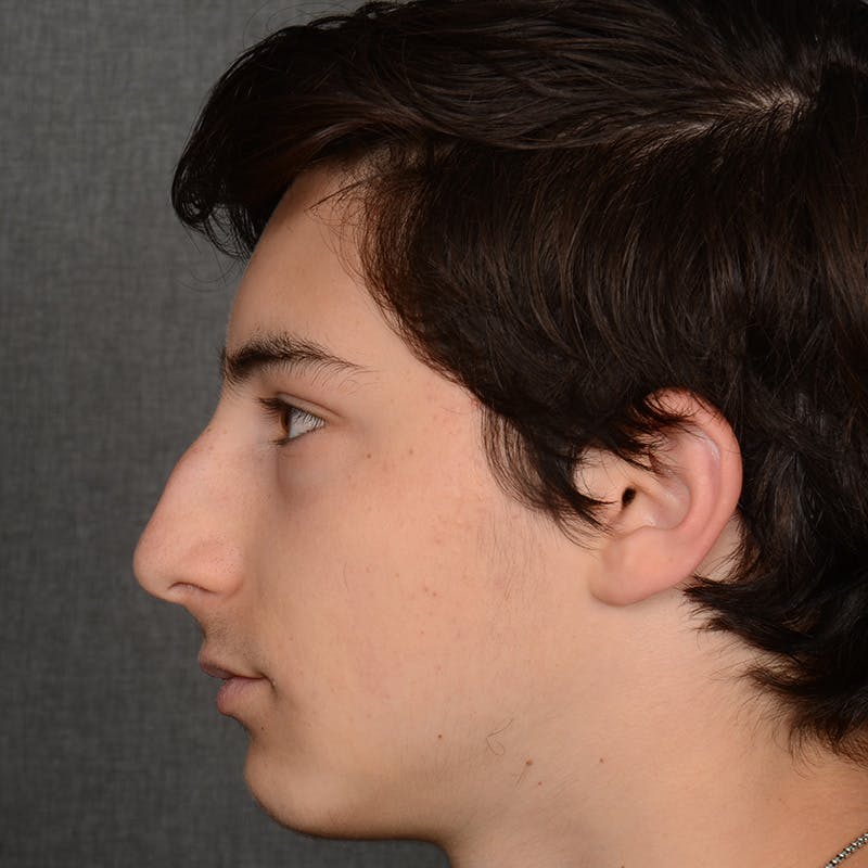 Male Rhinoplasty Before & After Gallery - Patient 105256 - Image 5