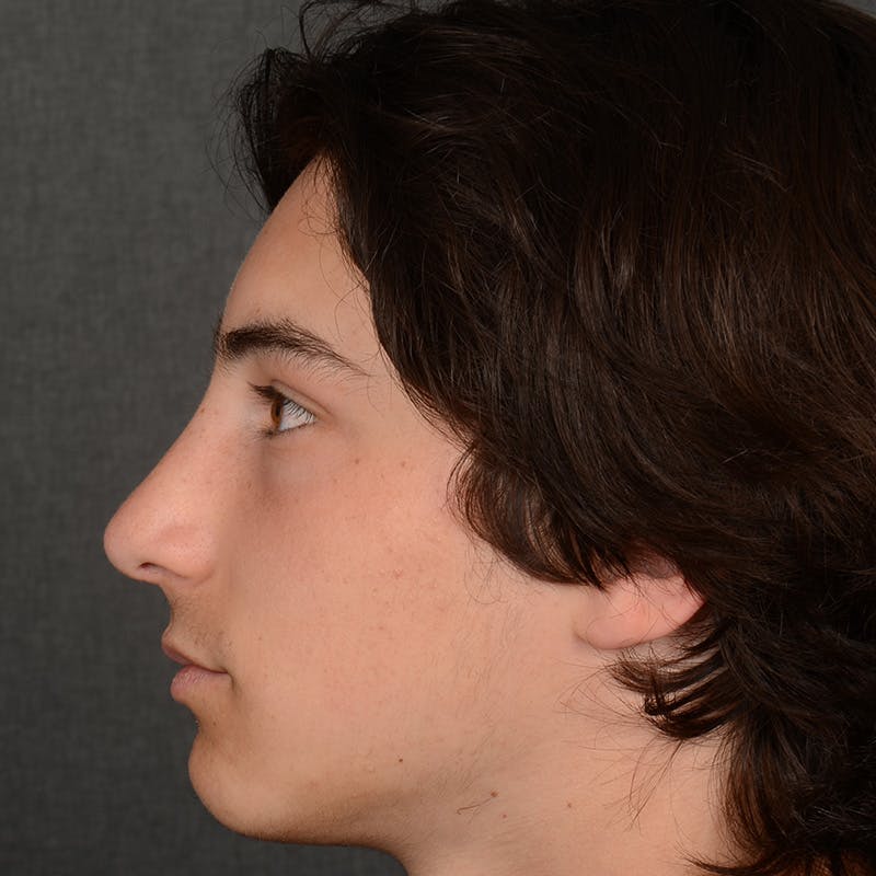 Male Rhinoplasty Before & After Gallery - Patient 105256 - Image 6