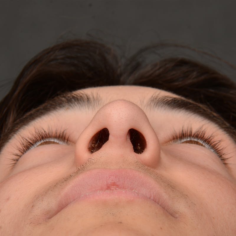Male Rhinoplasty Before & After Gallery - Patient 105256 - Image 7