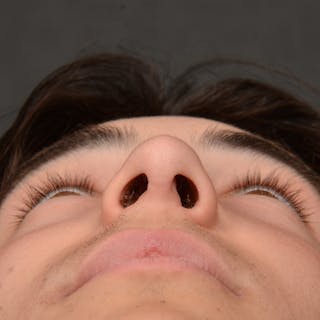 Male Rhinoplasty Before & After Gallery - Patient 105256 - Image 8