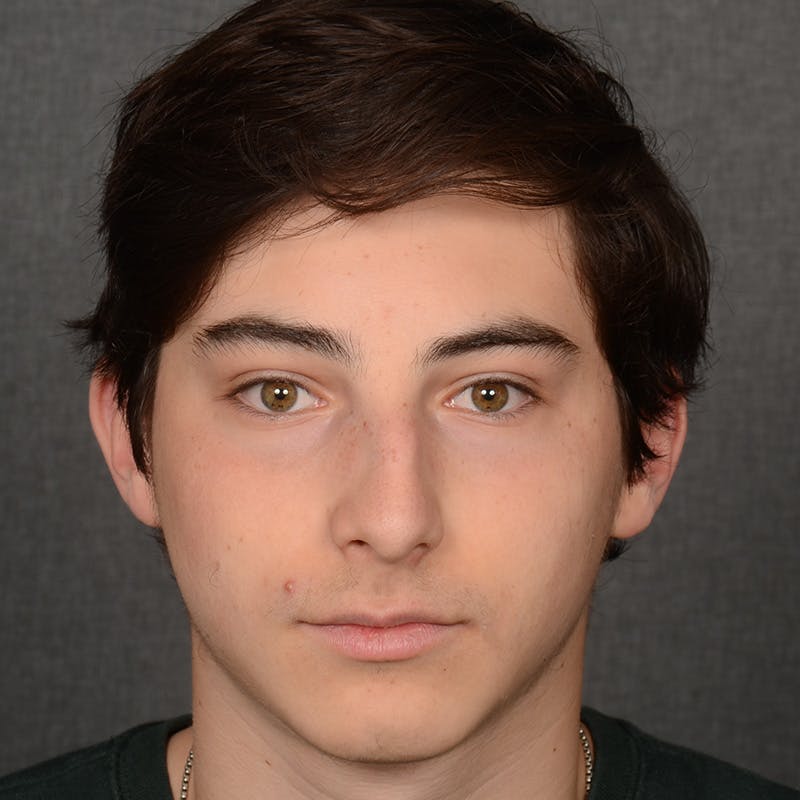 Male Rhinoplasty Before & After Gallery - Patient 105256 - Image 1