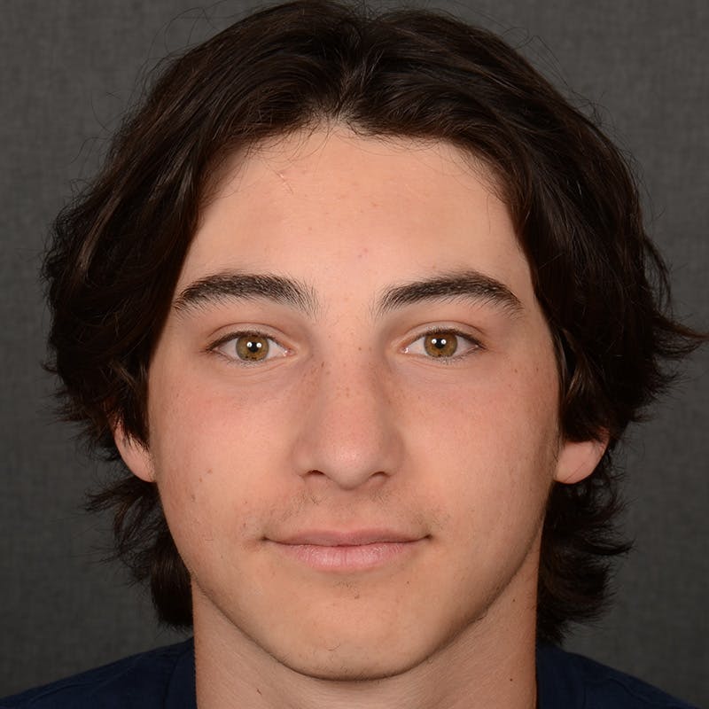 Male Rhinoplasty Before & After Gallery - Patient 105256 - Image 2