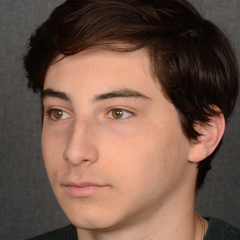 Male Rhinoplasty Before & After Gallery - Patient 105256 - Image 3