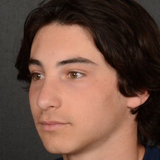 Male Rhinoplasty Before & After Gallery - Patient 105256 - Image 4