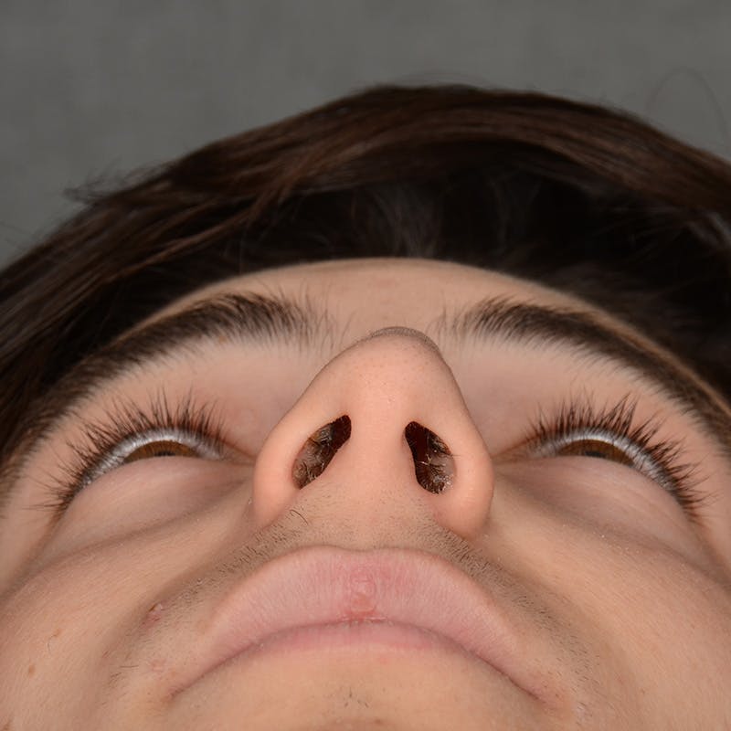 Male Rhinoplasty Before & After Gallery - Patient 105256 - Image 8