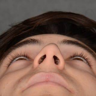 Male Rhinoplasty Before & After Gallery - Patient 105256 - Image 8