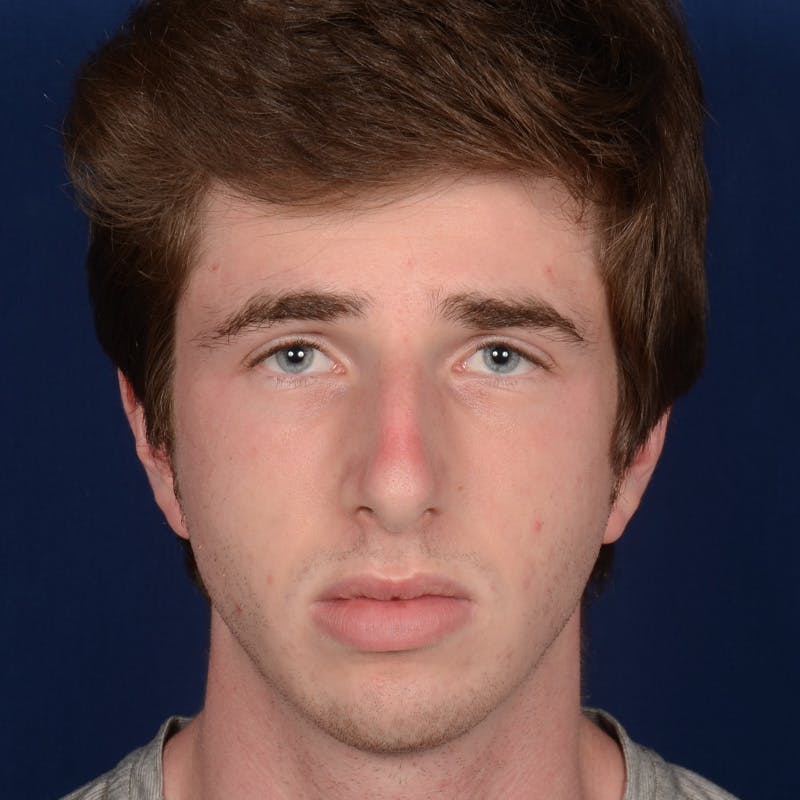 Male Rhinoplasty Before & After Gallery - Patient 165904 - Image 1