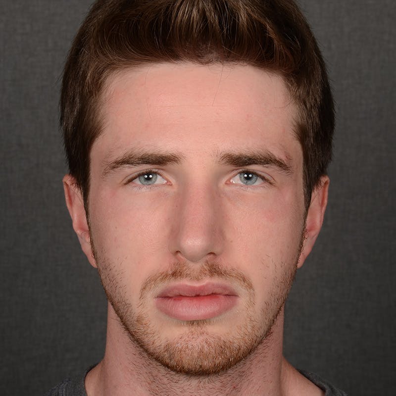 Male Rhinoplasty Before & After Gallery - Patient 165904 - Image 2