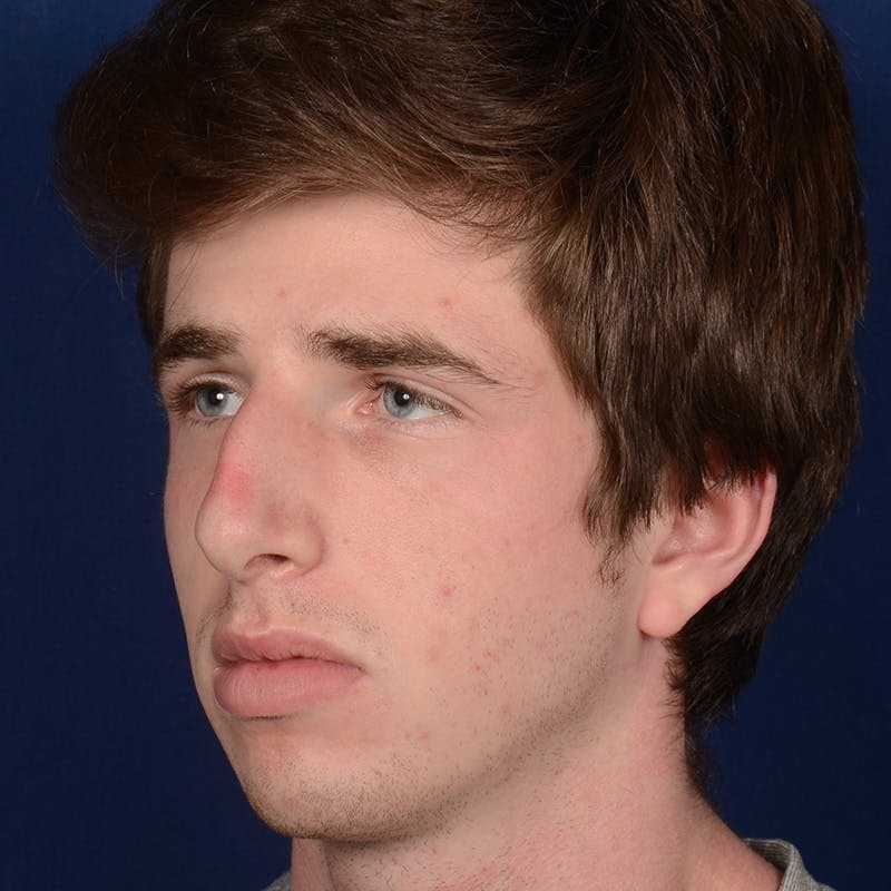 Male Rhinoplasty Before & After Gallery - Patient 165904 - Image 3