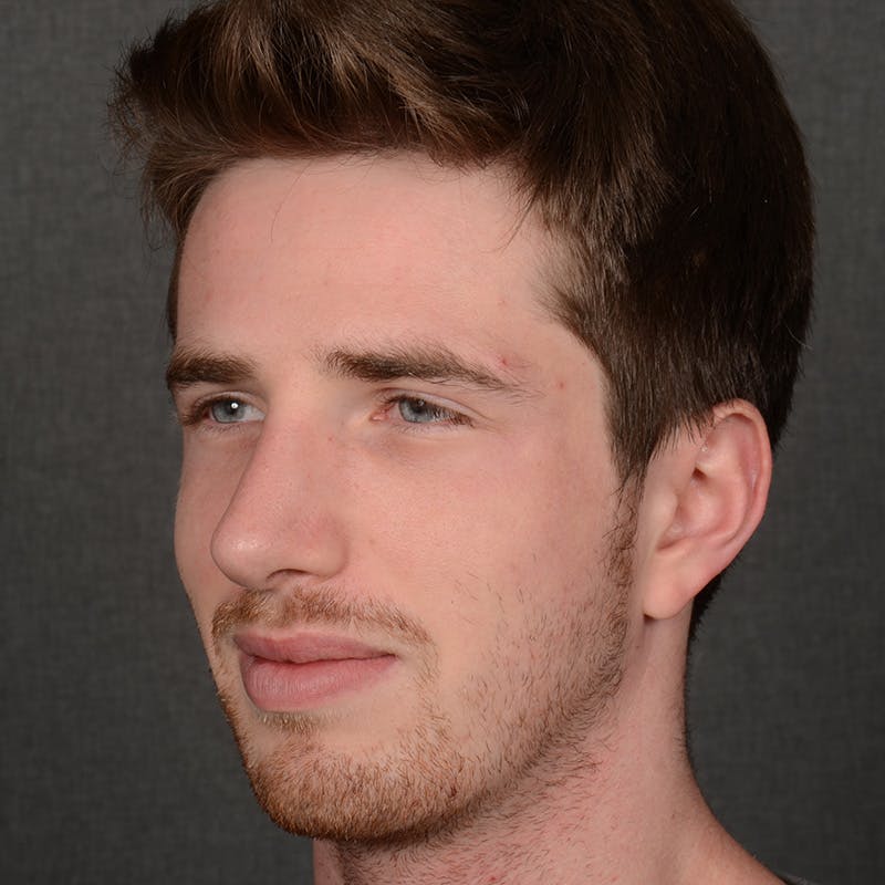 Male Rhinoplasty Before & After Gallery - Patient 165904 - Image 4