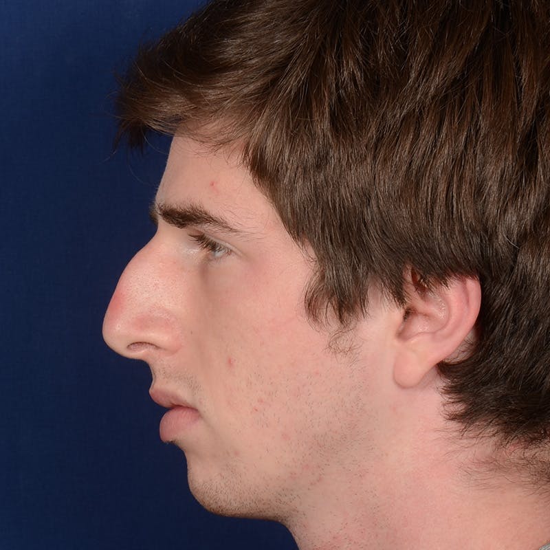 Male Rhinoplasty Before & After Gallery - Patient 165904 - Image 5
