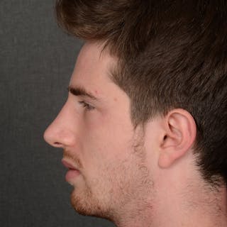 Male Rhinoplasty Before & After Gallery - Patient 165904 - Image 6