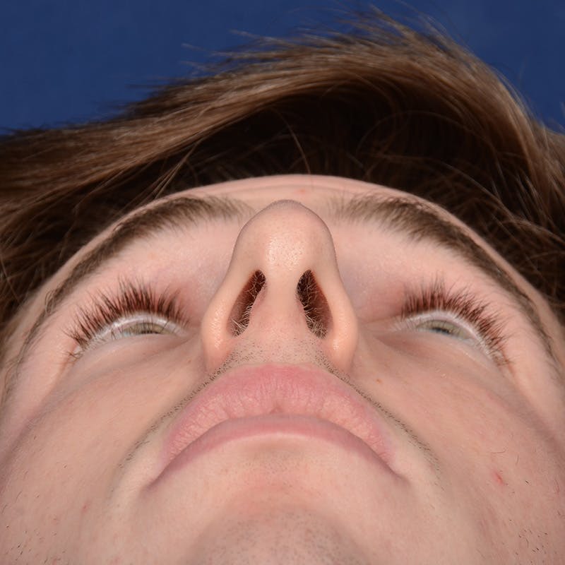 Male Rhinoplasty Before & After Gallery - Patient 165904 - Image 7