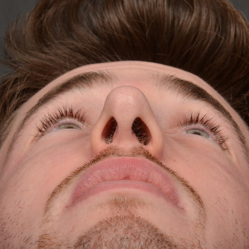 Male Rhinoplasty Before & After Gallery - Patient 165904 - Image 8