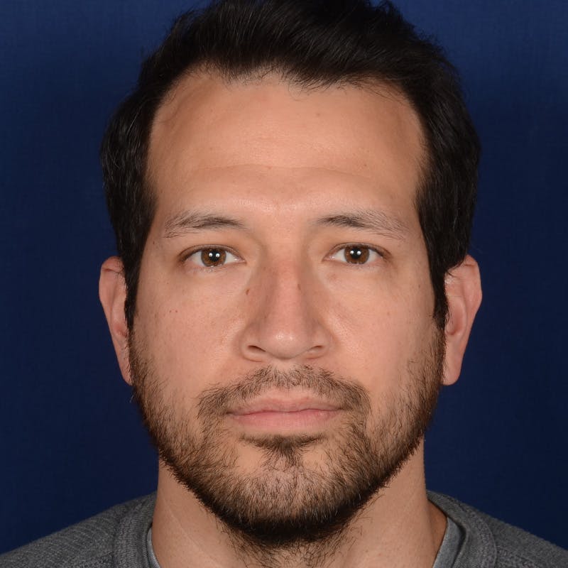 Male Rhinoplasty Before & After Gallery - Patient 205221 - Image 1
