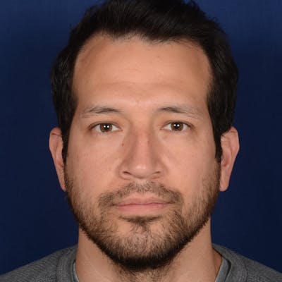 Male Rhinoplasty Before & After Gallery - Patient 205221 - Image 1