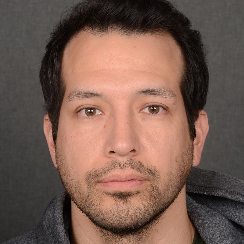 Male Rhinoplasty Before & After Gallery - Patient 205221 - Image 2