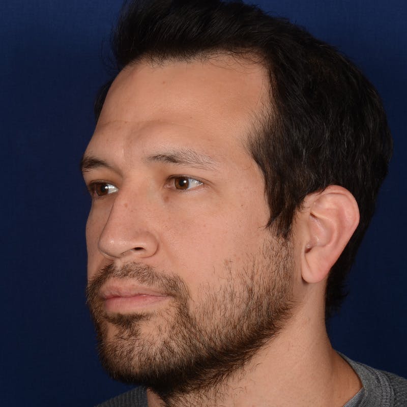 Male Rhinoplasty Before & After Gallery - Patient 205221 - Image 3