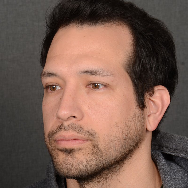 Male Rhinoplasty Before & After Gallery - Patient 205221 - Image 4