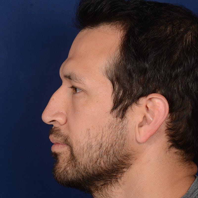 Male Rhinoplasty Before & After Gallery - Patient 205221 - Image 5
