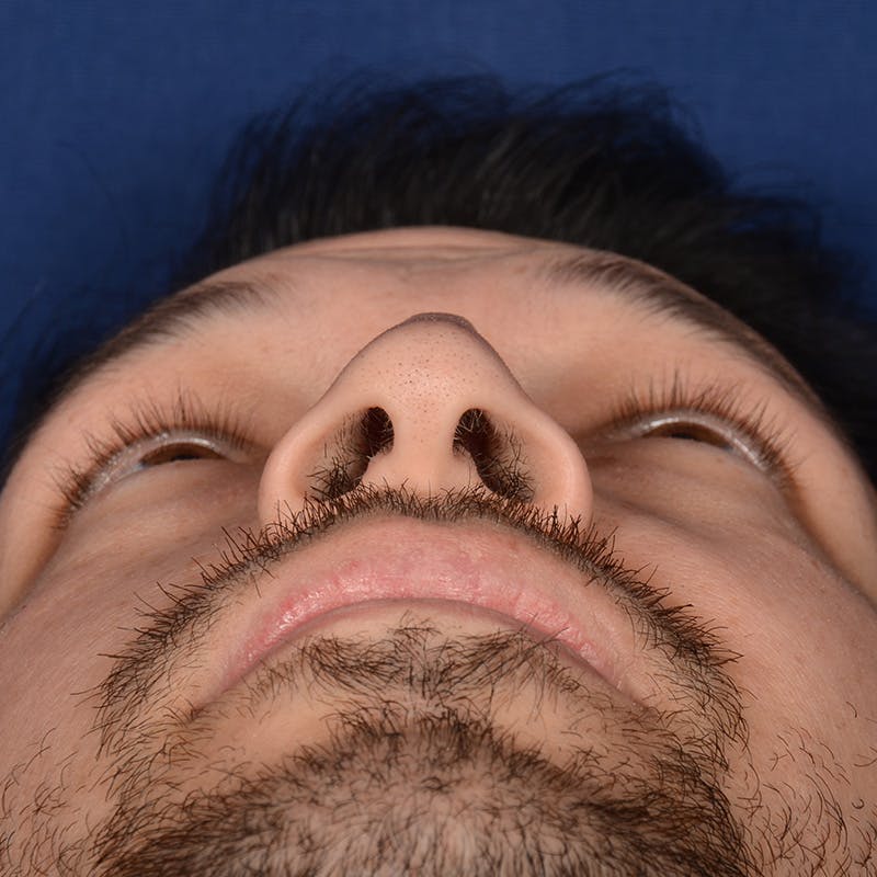 Male Rhinoplasty Before & After Gallery - Patient 205221 - Image 7