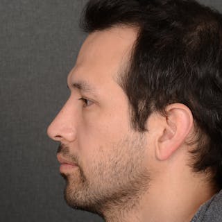 Male Rhinoplasty Before & After Gallery - Patient 205221 - Image 6