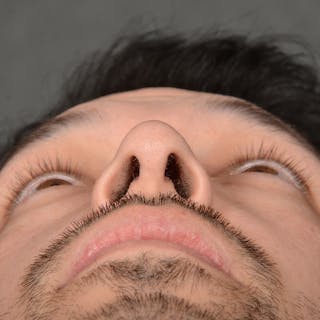 Male Rhinoplasty Before & After Gallery - Patient 205221 - Image 8