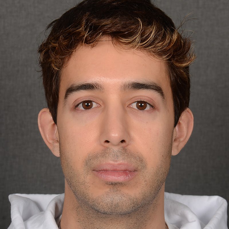 Male Rhinoplasty Before & After Gallery - Patient 405011 - Image 2