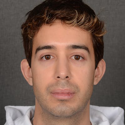 Male Rhinoplasty Before & After Gallery - Patient 405011 - Image 2