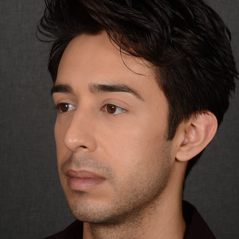 Male Rhinoplasty Before & After Gallery - Patient 405011 - Image 3