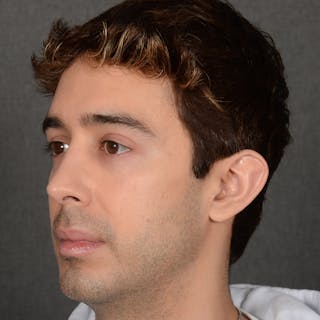 Male Rhinoplasty Before & After Gallery - Patient 405011 - Image 4