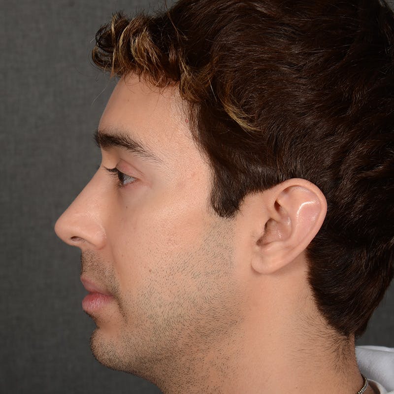 Male Rhinoplasty Before & After Gallery - Patient 405011 - Image 6