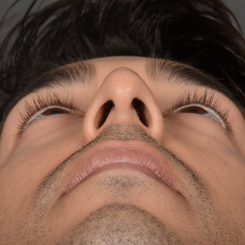 Male Rhinoplasty Before & After Gallery - Patient 405011 - Image 7