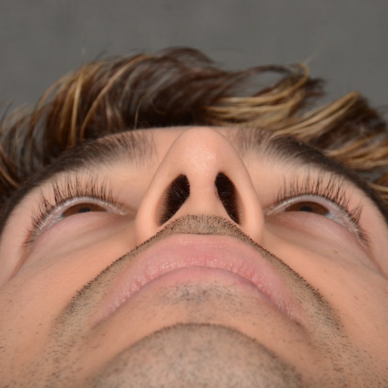 Male Rhinoplasty Before & After Gallery - Patient 405011 - Image 8