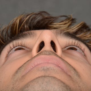 Male Rhinoplasty Before & After Gallery - Patient 405011 - Image 8