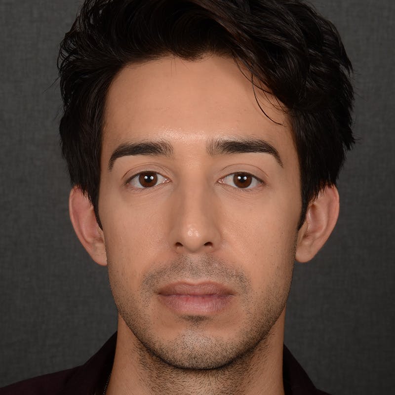 Male Rhinoplasty Before & After Gallery - Patient 405011 - Image 1