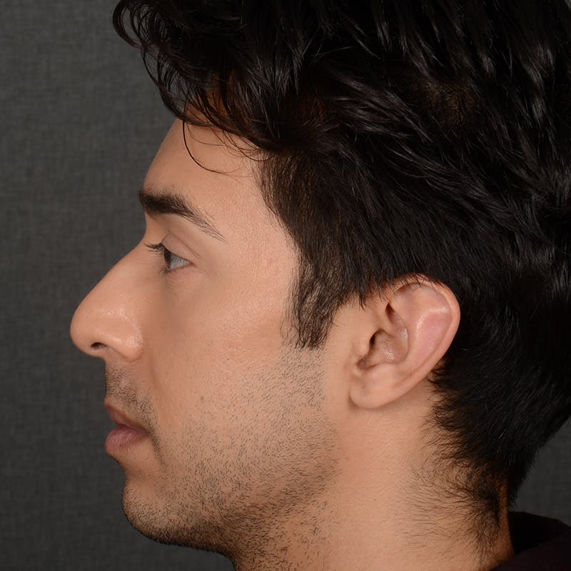 Male Rhinoplasty Before & After Gallery - Patient 405011 - Image 5