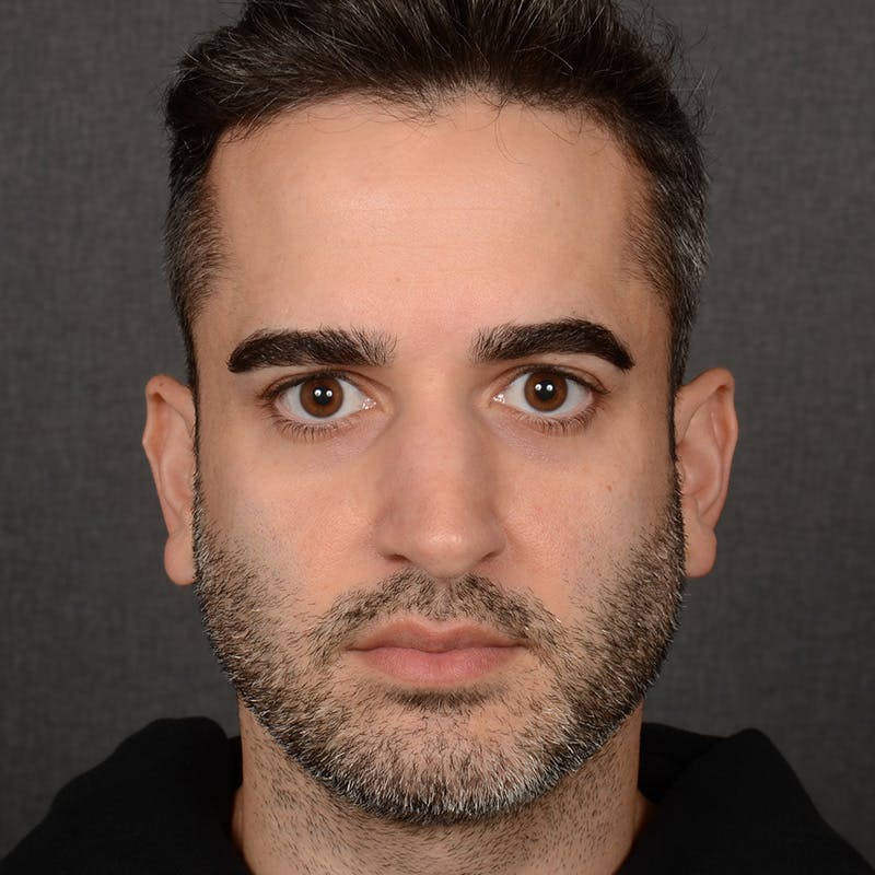 Male Rhinoplasty Before & After Gallery - Patient 216236 - Image 1